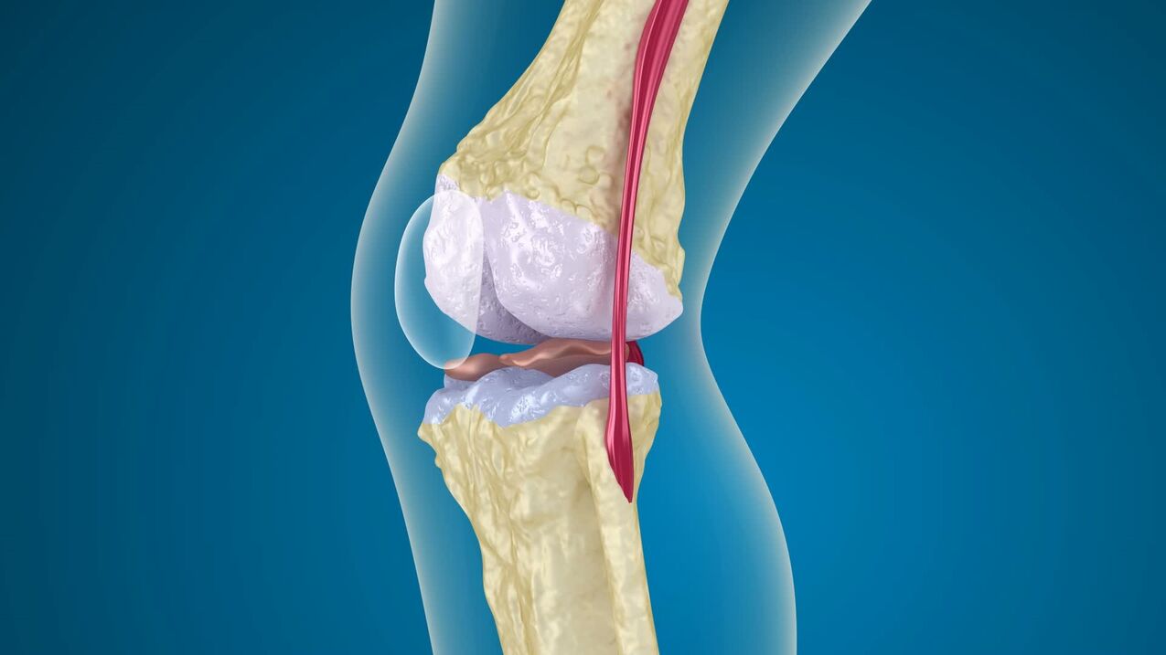 Деструкция коленного сустава и артропатия
