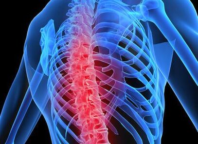 Грудной остеохондроз